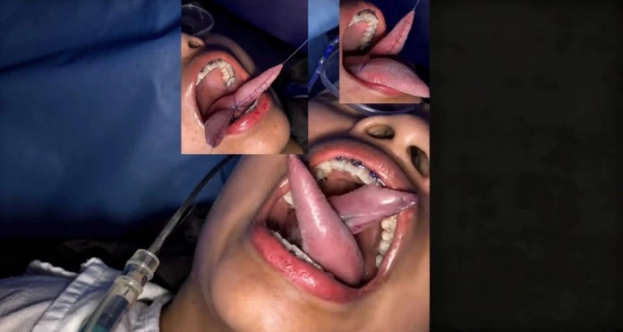 Côte d'Ivoire : Une jeune femme dans le coma après un piercing de langue qui a mal tourné