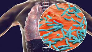 Tuberculose au Cameroun : près de 27 000 cas notifiés en 2025, des efforts accrus nécessaires